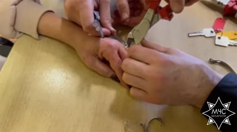 В Бобруйске женщина не смогла снять кольцо перед наложением гипса: на помощь пришли спасатели