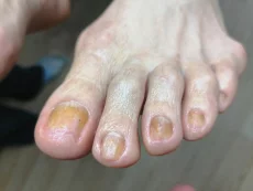 Подолог педикюр