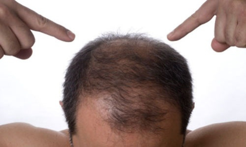 Загуститель волос решит проблему с облысением