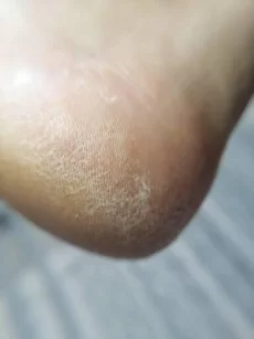 Подология подолог