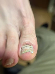 Подология подолог