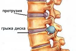 Травма: межпозвоночная грыжа