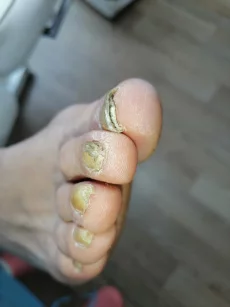 Подолог педикюр